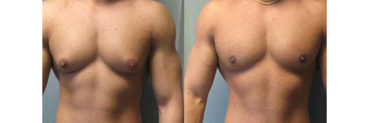 Jinekomasti Spor İle Geçer Mi? Jinekomasti Spor İle Geçer Mi?