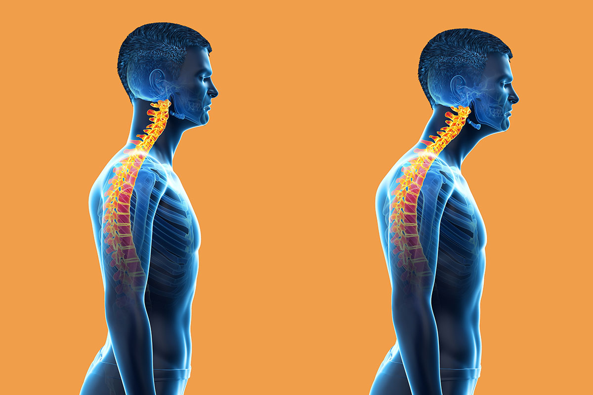 Issued to to forward. Forward head posture. Осанка. Мужская осанка. Компьютерная осанка шея.